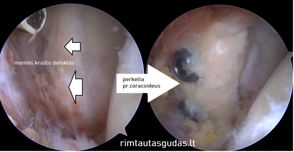 Artroskopinis pr.coracoideus perkėlimas