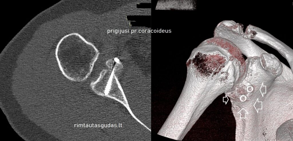 Artroskopinis pr.coracoideus perkėlimas