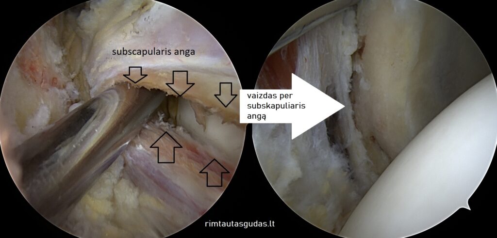 Kaip atliekama artroskopinė peties rekonstrukcija (@Latarjet)