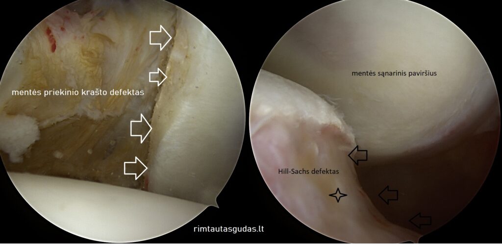 Kaip atliekama artroskopinė peties rekonstrukcija (@Latarjet)