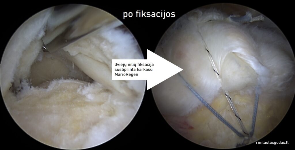 Artroskopinis biologinio karkaso įterpimas į sausgyslę