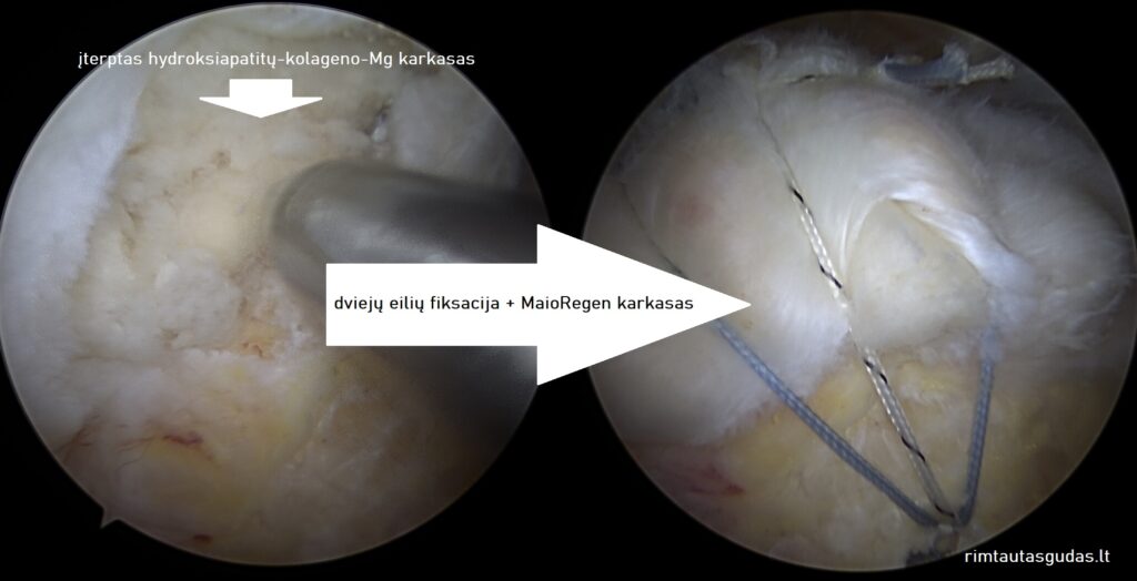 Artroskopinis biologinio karkaso įterpimas į sausgyslę