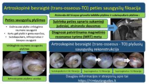 trans osseous rotator cuff repair R.Gudas