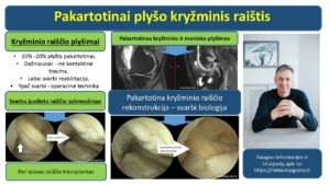 Pakartotinai plyso kryzminis raistis