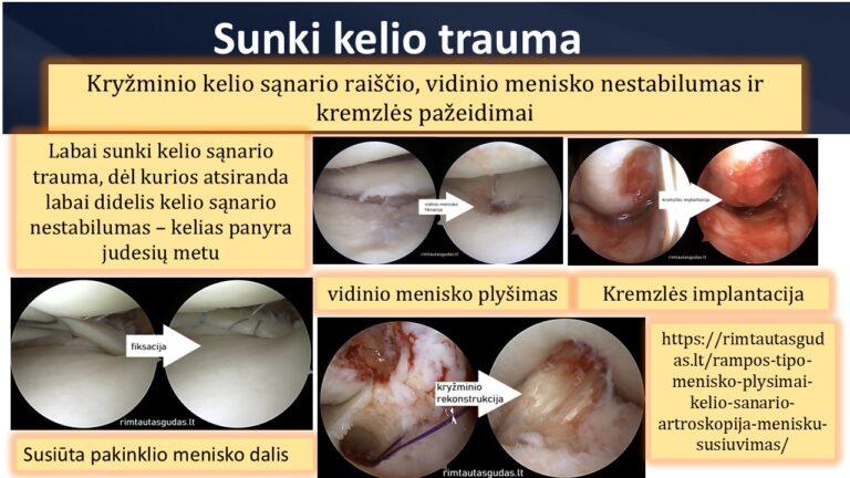 Sunkiu kelio traumu gydymas