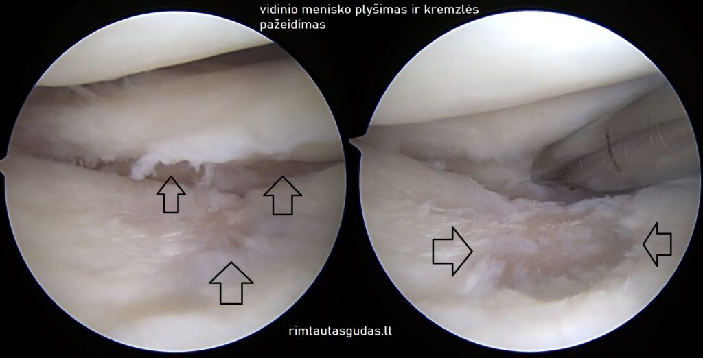 Donoro menisko transplantacija