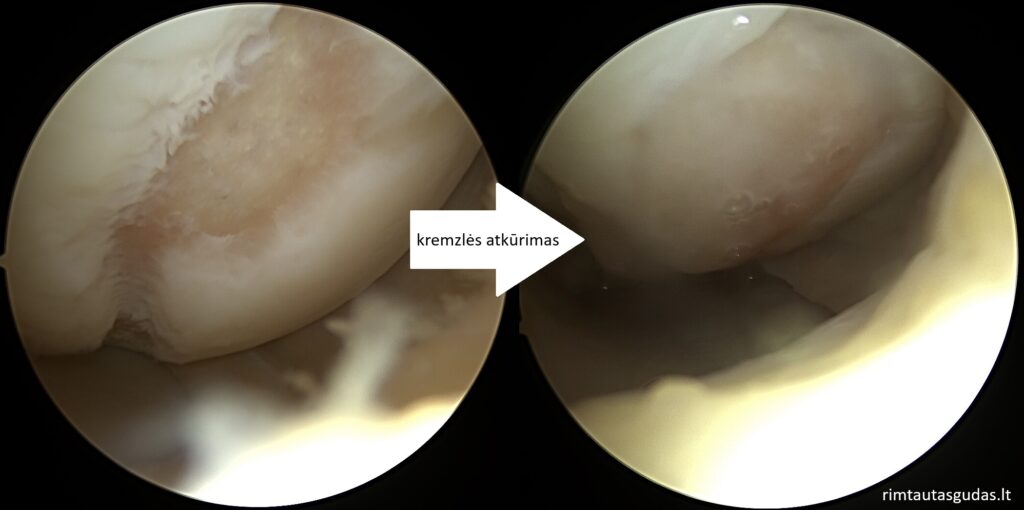 Kremzlės atkūrimas ir menisko susiuvimas vienu metu