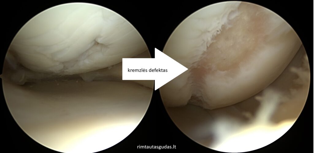 Kremzlės atkūrimas ir menisko susiuvimas vienu metu