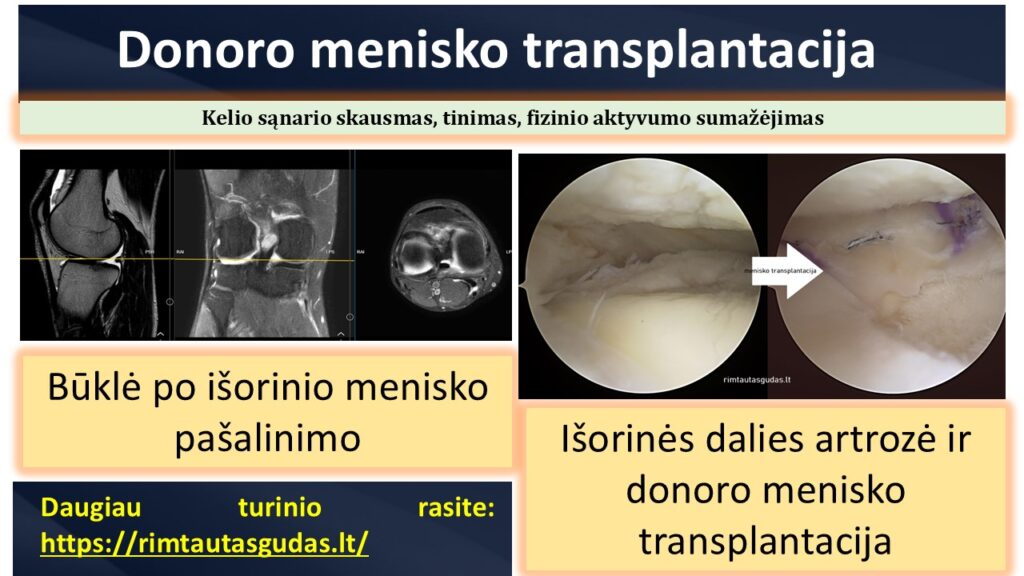 menisko donoro transplantacija