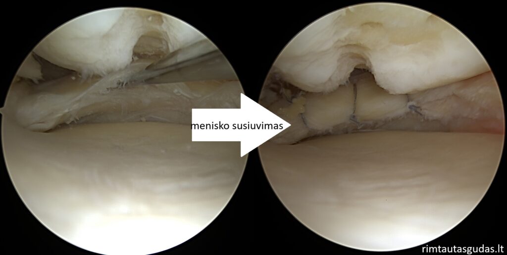 Kremzlės atkūrimas ir menisko susiuvimas vienu metu