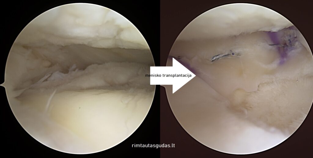 Donoro menisko transplantacija