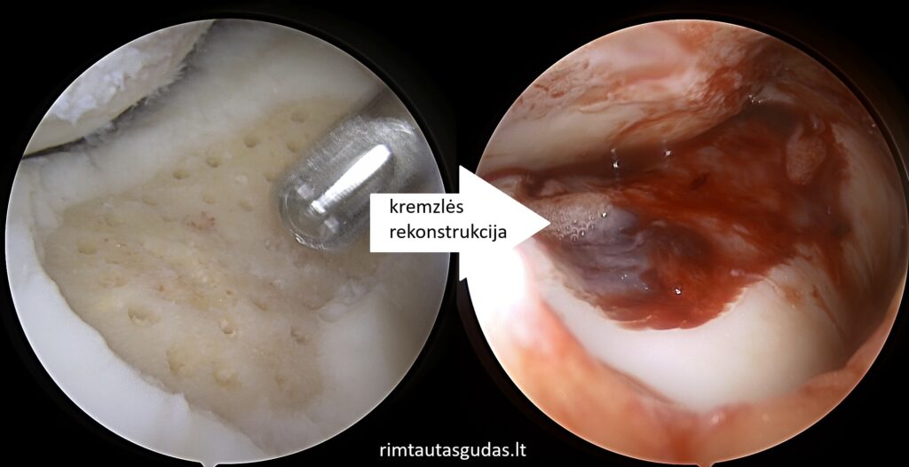 Išorinio menisko ir kremzlės rekonstrukcija