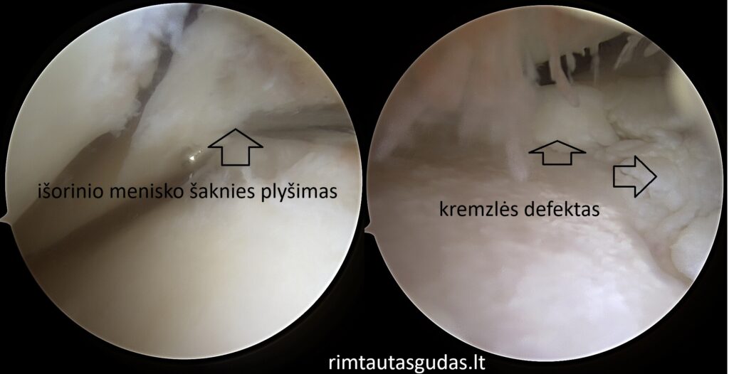 Išorinio menisko ir kremzlės rekonstrukcija