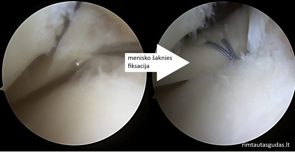 Išorinio menisko ir kremzlės rekonstrukcija