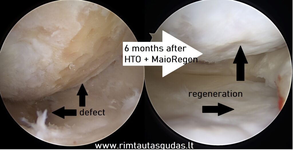 6 months after HTO and Maioregen