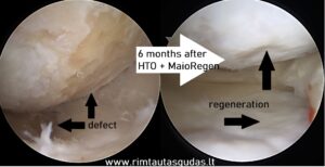 6 months after HTO and Maioregen