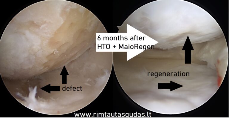 6 months after HTO and Maioregen