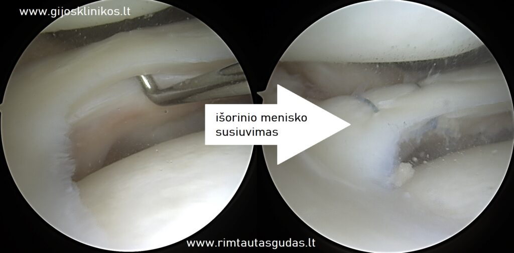 Išorinio menisko All-Inside susiuvimas su PKR rekonstrukcija 5 Išorinio menisko „All-Inside“ susiuvimas su PKR rekonstrukcija