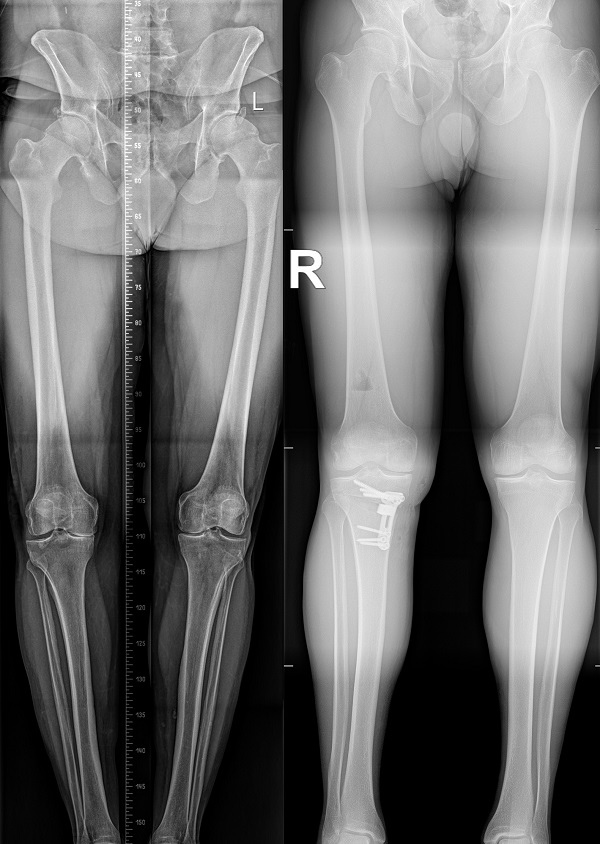 Pilnas kremzlės atsistatymas po HTO ir MaioRegen Chondroplus rekonstrukcijos: klinikinis atvejis