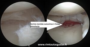 Pradinis 10 Isorinio menisko susiuvimas su kremzle