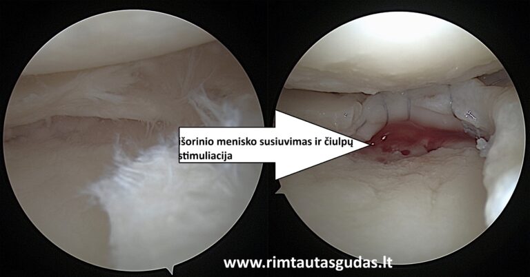 Isorinio menisko susiuvimas su kremzle