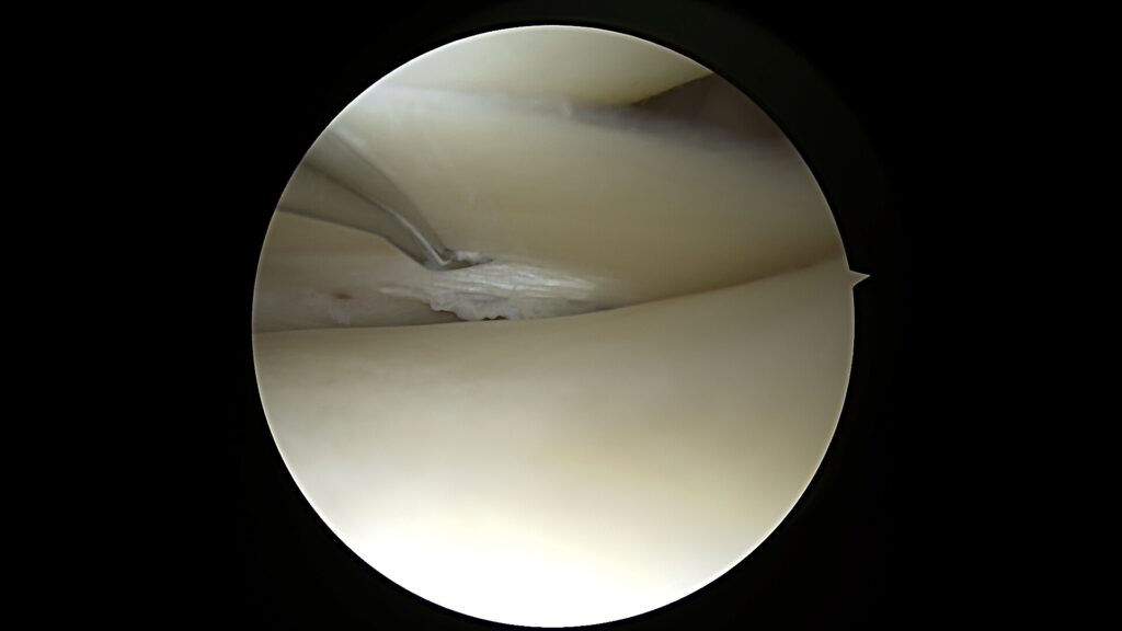Viso kelio sąnario rekonstrukcija – MENIX DUO, ACL, menisko šaknies fiksacija | Rimtautas Gudas 3 Viso kelio sąnario rekonstrukcija – MENIX DUO, ACL, menisko šaknies fiksacija | Rimtautas Gudas