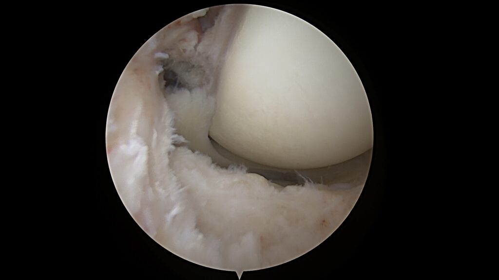 Viso kelio sąnario rekonstrukcija – MENIX DUO, ACL, menisko šaknies fiksacija | Rimtautas Gudas 4 Viso kelio sąnario rekonstrukcija – MENIX DUO, ACL, menisko šaknies fiksacija | Rimtautas Gudas