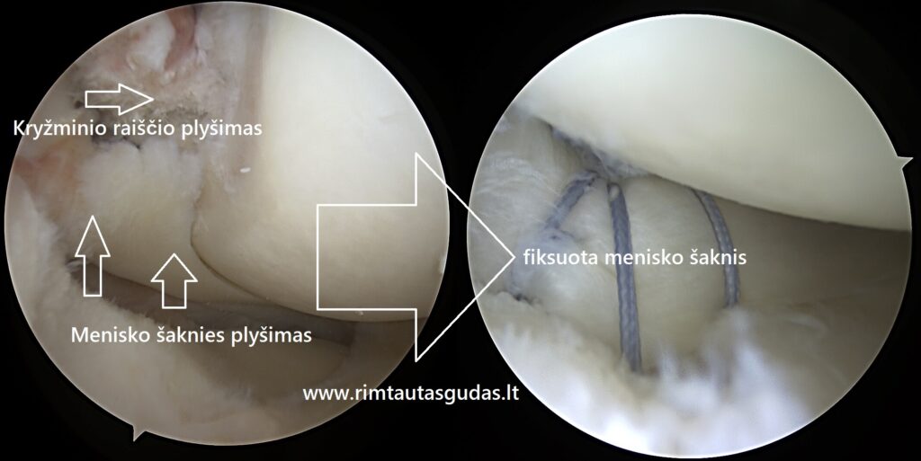 Viso kelio sąnario rekonstrukcija – MENIX DUO, ACL, menisko šaknies fiksacija | Rimtautas Gudas 5 Viso kelio sąnario rekonstrukcija – MENIX DUO, ACL, menisko šaknies fiksacija | Rimtautas Gudas
