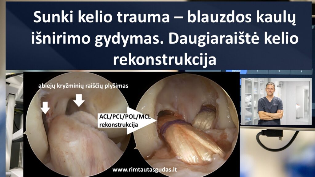 Sunki kelio sąnario trauma: blauzdos kaulų išnirimo gydymas atliekant daugiaraištę kelio rekonstrukciją