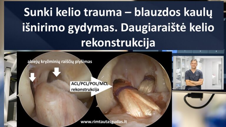 Sunki kelio sąnario trauma: blauzdos kaulų išnirimo gydymas atliekant daugiaraištę kelio rekonstrukciją