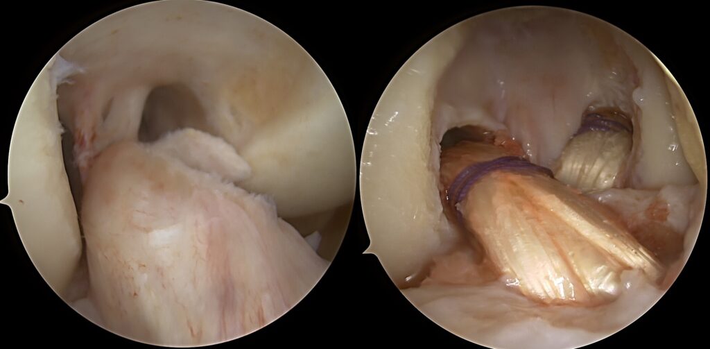 Sunki kelio sąnario trauma: blauzdos kaulų išnirimo gydymas atliekant daugiaraištę kelio rekonstrukciją