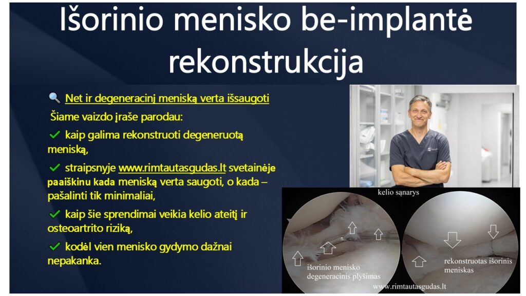 Isorinio menisko rekonstrukcija R.Gudas