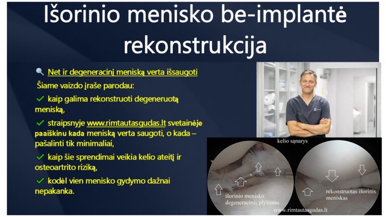Isorinio menisko rekonstrukcija R.Gudas