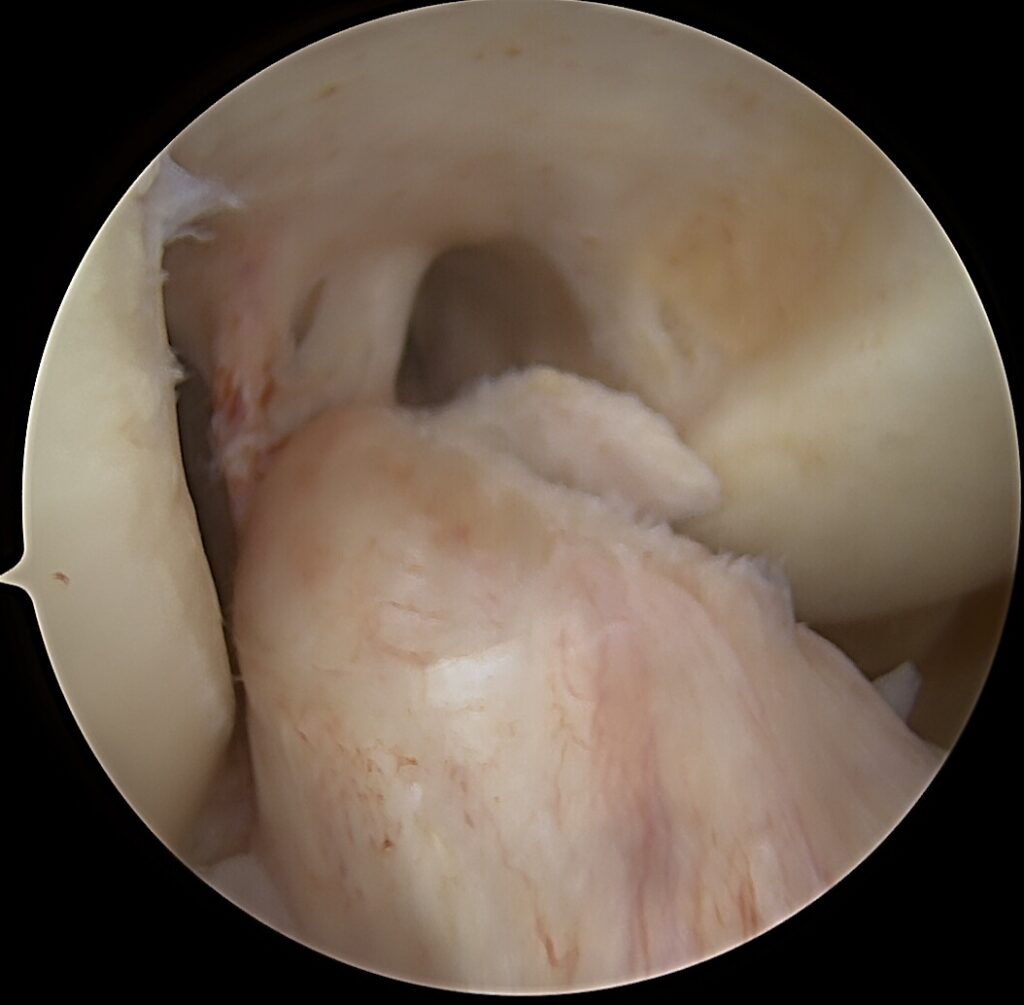 Sunki kelio sąnario trauma: blauzdos kaulų išnirimo gydymas atliekant daugiaraištę kelio rekonstrukciją