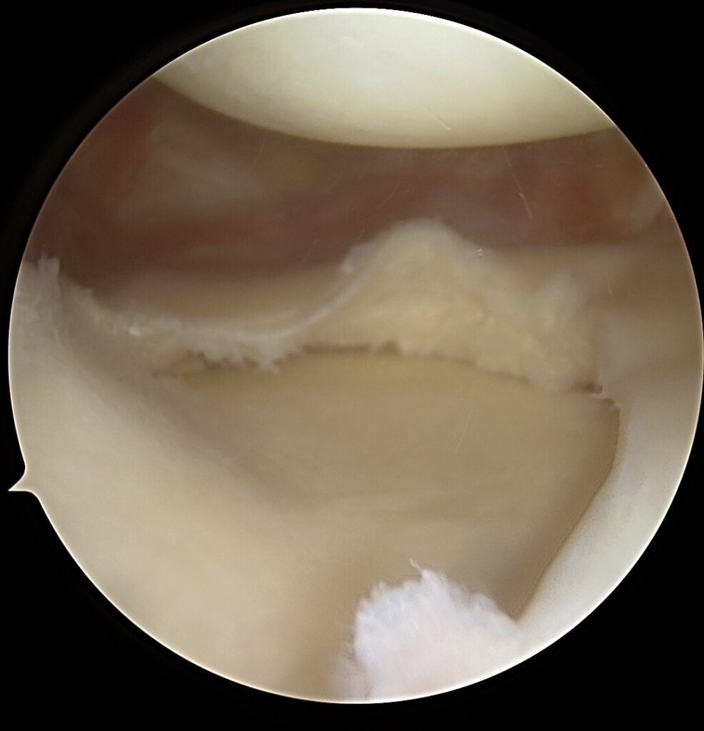 MCL rekonstrukcija, POL raištis, vidinis kelio nestabilumas