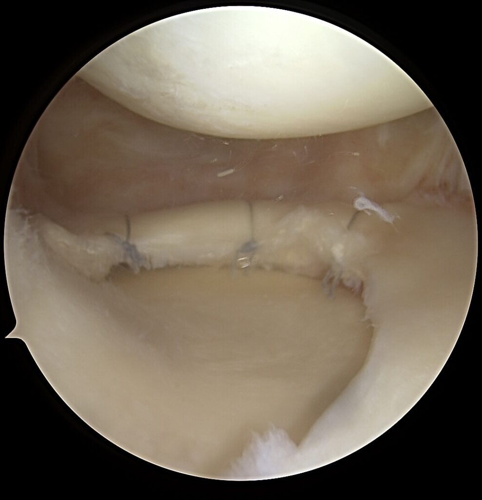 Sunki kelio sąnario trauma: blauzdos kaulų išnirimo gydymas atliekant daugiaraištę kelio rekonstrukciją