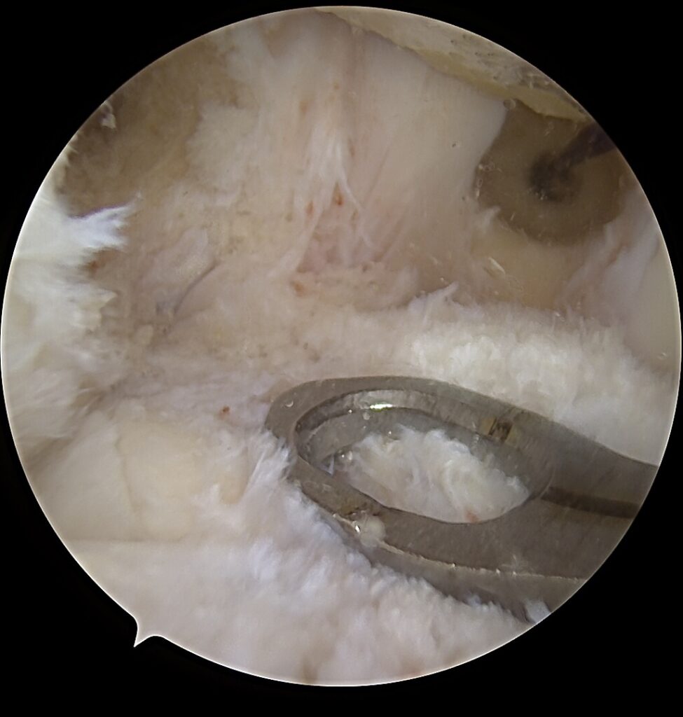 MCL rekonstrukcija, POL raištis, vidinis kelio nestabilumas