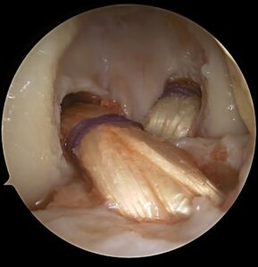 KneeArthroscopy 2025 12 15 235804 Gudas Rimtautas Still 026