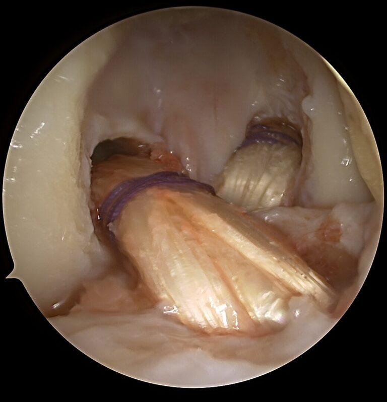 KneeArthroscopy 2025 12 15 235804 Gudas Rimtautas Still 026