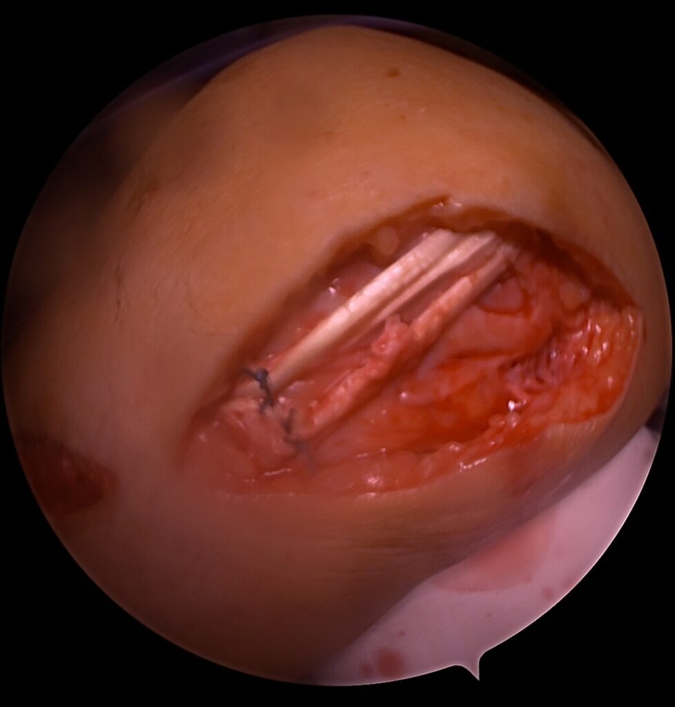 MCL rekonstrukcija, POL raištis, vidinis kelio nestabilumas