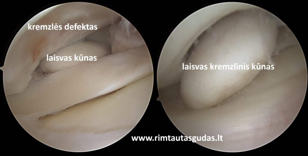 Kelio sąnario kremzlės ir kaulo defekto rekonstrukcija naudojant „MaioRegen Prime“