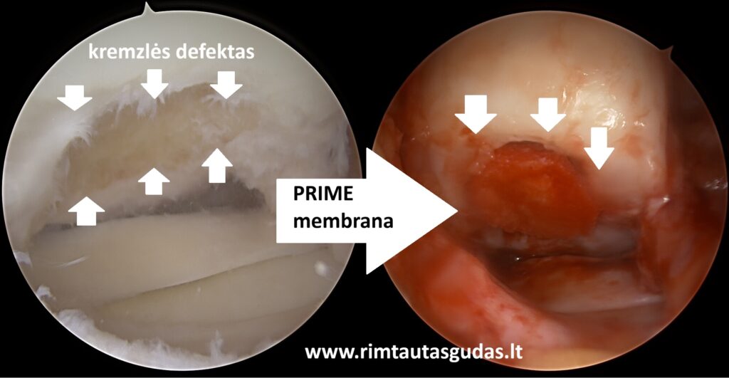 Kelio sąnario kremzlės ir kaulo defekto rekonstrukcija naudojant „MaioRegen Prime“