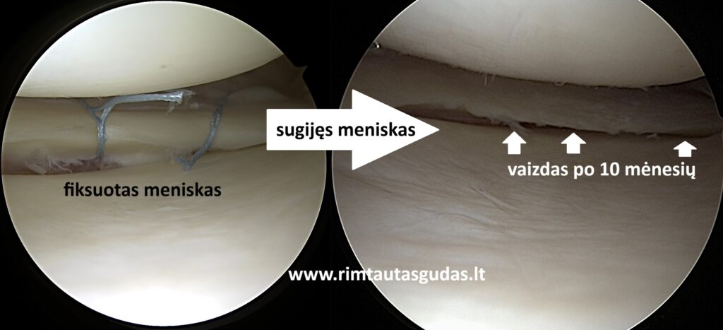 Kryžminio raiščio ir meniskų rekonstrukcija: pilnas sugijimas po 10 mėnesių 6 Kryžminio raiščio ir meniskų rekonstrukcija: pilnas sugijimas po 10 mėnesių