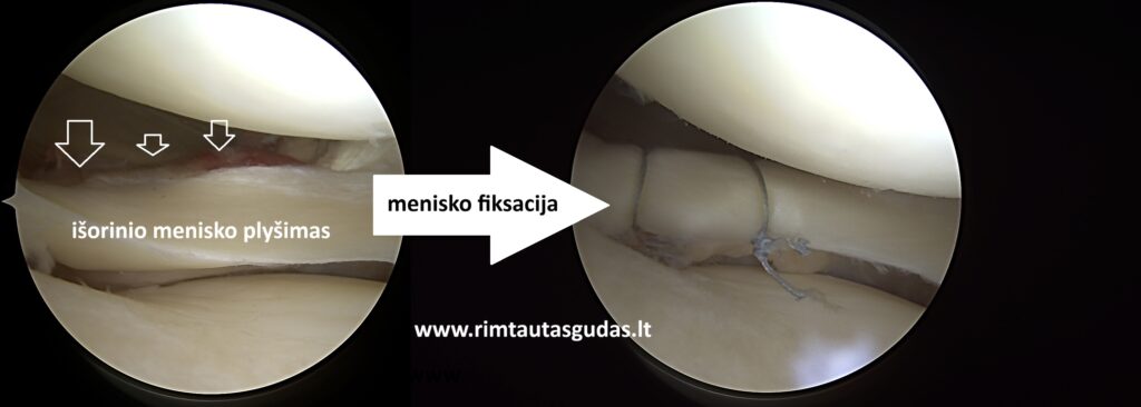 Kryžminio raiščio ir meniskų rekonstrukcija: pilnas sugijimas po 10 mėnesių 4 Kryžminio raiščio ir meniskų rekonstrukcija: pilnas sugijimas po 10 mėnesių
