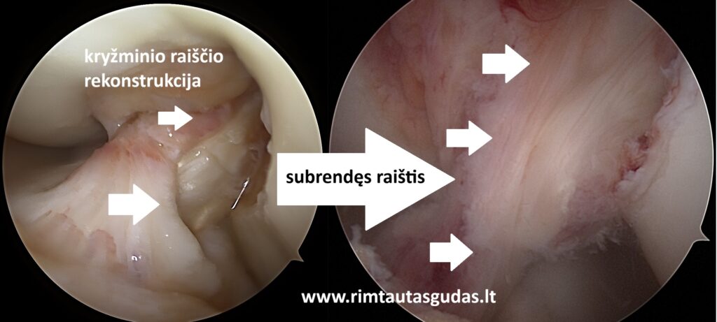 Kryžminio raiščio ir meniskų rekonstrukcija: pilnas sugijimas po 10 mėnesių 7 Kryžminio raiščio ir meniskų rekonstrukcija: pilnas sugijimas po 10 mėnesių