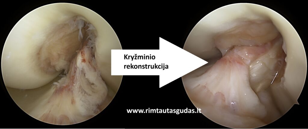 Kryžminio raiščio ir meniskų rekonstrukcija: pilnas sugijimas po 10 mėnesių 3 Kryžminio raiščio ir meniskų rekonstrukcija: pilnas sugijimas po 10 mėnesių