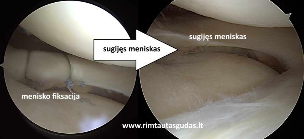 Kryžminio raiščio ir meniskų rekonstrukcija: pilnas sugijimas po 10 mėnesių 5 Kryžminio raiščio ir meniskų rekonstrukcija: pilnas sugijimas po 10 mėnesių