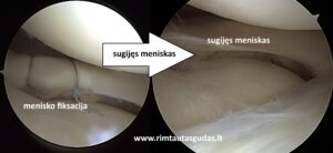 SPORTINĖ KELIO TRAUMA Kada reikia operacijos? Gyd. Rimtautas Gudas Ortopedas-traumatologas