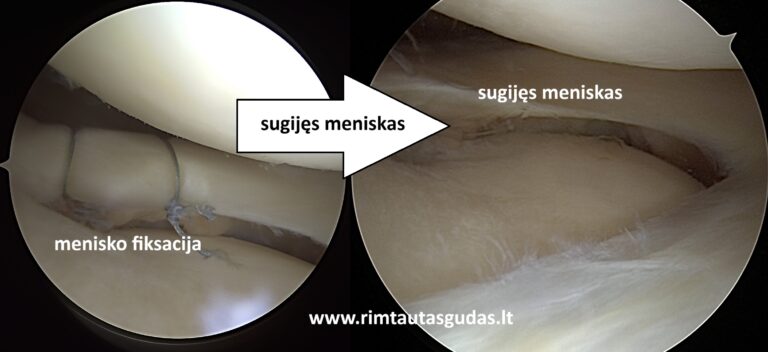 Sportinė kelio trauma: kada reikia operacijos, o kada galima gydyti be jos? 1 SPORTINĖ KELIO TRAUMA Kada reikia operacijos? Gyd. Rimtautas Gudas Ortopedas-traumatologas