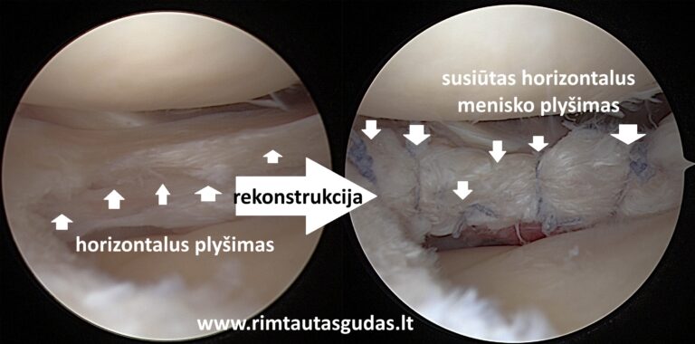Išorinio menisko degeneracinio horizontalaus plyšimo rekonstrukcija: biologinis pagrindimas ir klinikiniai rezultatai 1 isorinio menisko horizonatas